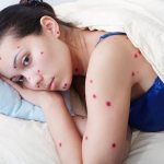 How to wash off Fukortsin from skin or hair after chickenpox?